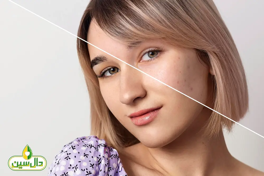 درمان جوش صورت، دلایل ابتلا و درمان های ساده و باورنکردنی آکنه
